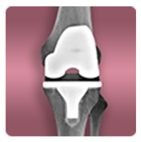 Bilateral Knee Replacement With Complication